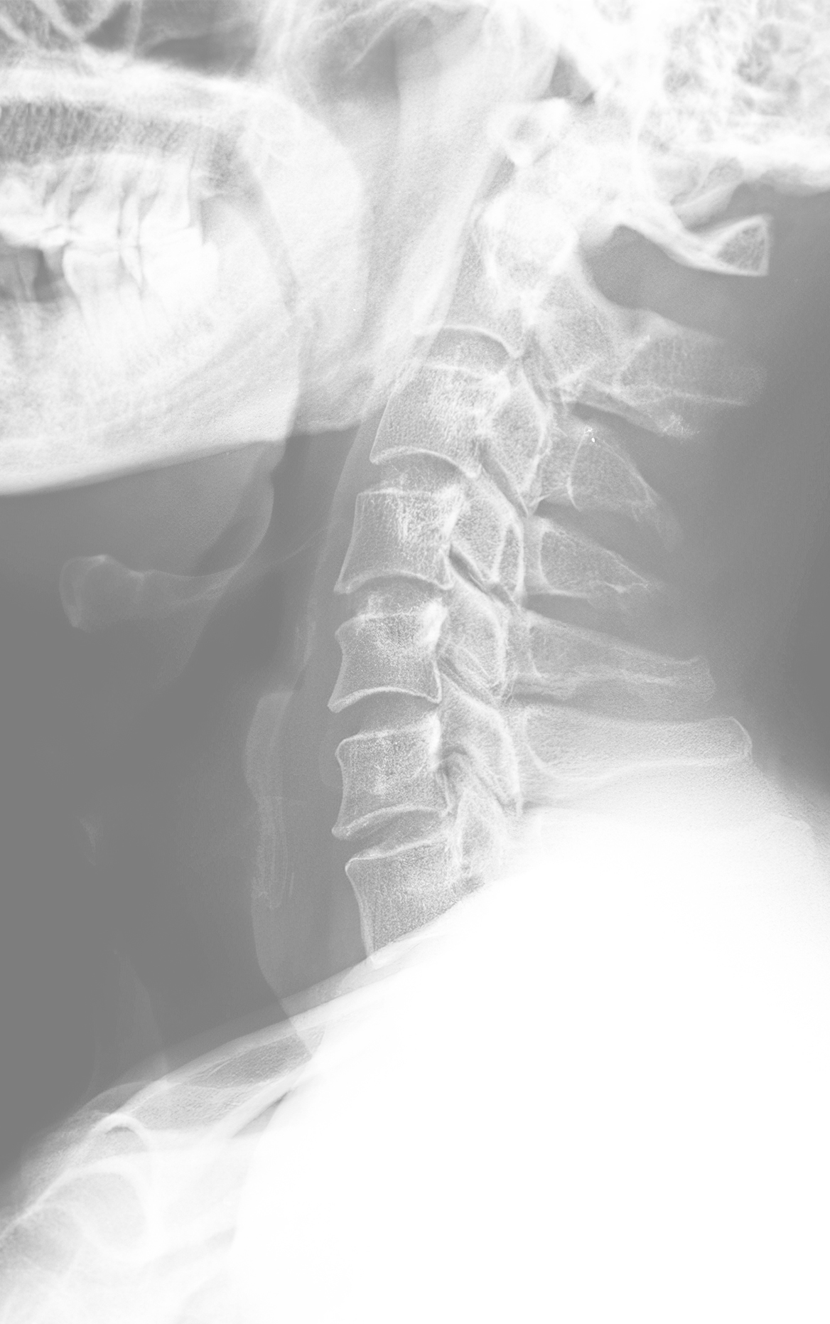 A close-up of a neck x-ray.